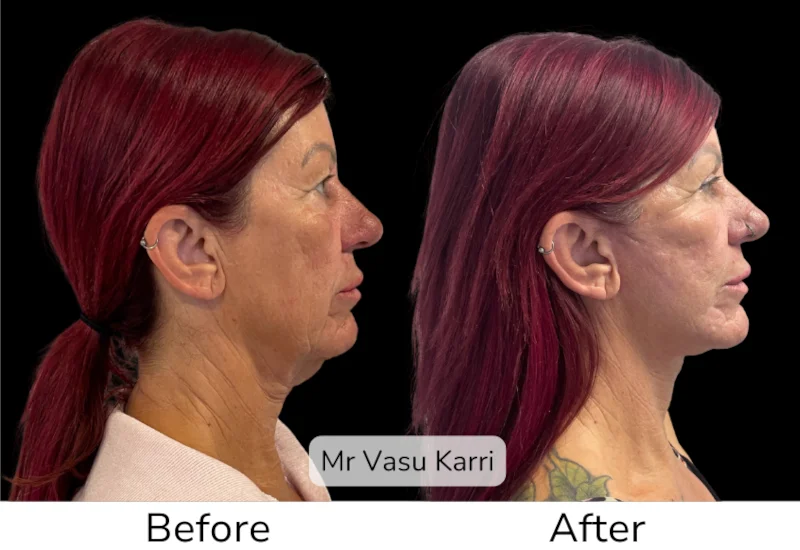 Facelift Patient 3 View 2